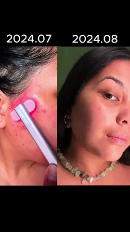 I love him so much!! #ledbeautywand #redlighttherapy #skincare 