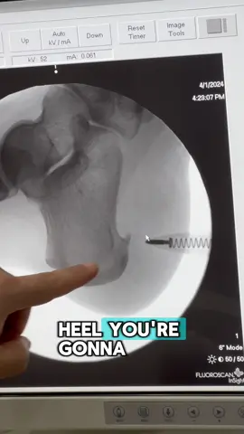 Let's look at a Heel Spur on an Xray 🩻 Heel Spurs are correctable with a simple procedure. Visit your podiatrist if you are experiencing pain on the bottom of your heel when walking. #heelspur #heelpain #painrelief #podiatry #bestfootdoctorny #foothealth #jamaica #queens #nyc #brooklyn