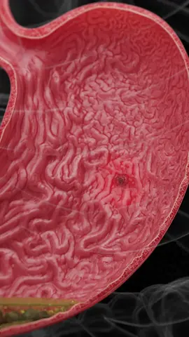 🔴 What Is a Bleeding Gastric Ulcer? 🔴 Learn about this serious condition, its symptoms, and why immediate medical attention is crucial. #HealthFacts #GastroHealth #SciePro #EduTikTok #Science #meded #medical #anatomy #sciart #3d #animation #vray #zbrush #autodesk #3dmodel #medstudent #education #health #body #gastric
