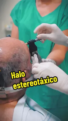- **Dispositivo Médico**: O halo estereotáxico é um dispositivo usado em neurocirurgia e Radiocirurgia. 🧠 - **Imobilização Precisa**: Serve para manter a cabeça de um paciente imobilizada e em uma posição precisa. 🎯 - **Estrutura**: Composto por um anel de metal que é fixado ao crânio com pequenos pinos. 🔩 - **Finalidade**: Permite aos médicos localizar e tratar alvos específicos no cérebro com alta precisão 🏥 Dr. Bruno Fernandes CRM 3918 | RQE 3496 #Neurocirurgia #Radioterapia #PrecisãoCirúrgica #TratamentoCerebral #SaúdeAvançada