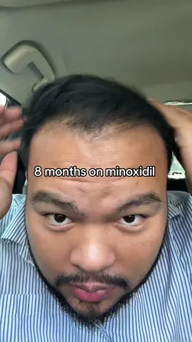 link in bio‼️ it worked for me so why not you? #hair #hairtransformation #hairloss #hairgrowth #menshealth #menshair #minoxidil #hairlinecheck 