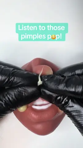 Listen to those pimples pop! Very satisfying asmr video🍿🦠 #pimple #acne #cyst #pimplepopper #satisfy #squeezing #asmr #asmrsounds #asmrvideo 