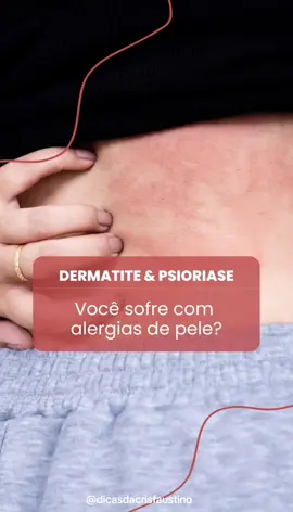 #psioriase #dermatite #alergia #pele #alergias #ozonio #ozonioterapia 