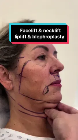 2 months after deep plane facelift, deep necklift, lip lift and blepharoplasty. All done under local anesthesia😉 How do you like the result?😊 📲 If you want to make an appointment, contact us at contact@v-clinic.cz #facelift #necklift #liplift #blepharoplasty #plasticsurgery #plasticsurgeon #plastickachirurgie #ventruba #vclinic #transformation #beforeandafter