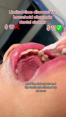 My brother's front teeth are blackened. Let me help him clean them up. This household ultrasonic dental cleaner is simple and safe to use. #musicfestivals#wellness#TikTokShopMothersDay #oralcavity #oralhygiene#demtalstain#nbgrlvs#tiktokshop#tiktok#foryou #TikTokShopSummerSale #DealsForYouDays