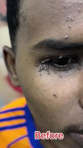 Waxaan ka jarnay xonqor ama warts oo wajiga quruxdiisa ka haleysay#warts #wart #wartsremoval #drakdermaclinic #muqdishotiktok #somalitiktok #dhaqtarka_maqarka_timaha_cidiyaha  only for education