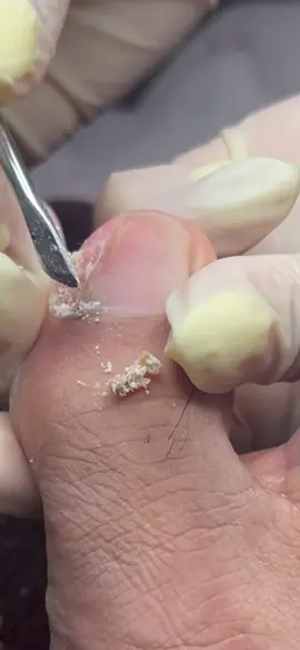 #ingrowntoenail #pedicure #feetcare #Toronto #fyp #satisfyingvideo 