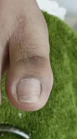 ang nipis ng kuko,hirap tanggalin ang dryskin #satisfying #manikuristangligaw #ingrowntoenail 