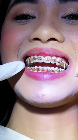 Replying to @camspinon Sige doc higpitan mo pa😭 Chipmunk elastics aaaww!😭🦷 #asmr #elastics #chipmunk #braces #adjustmentday #bracesjourney #fyp  #camillevelasco #teethtok