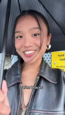 16 months Braces transformation in 7 seconds oop #bracestransformation #bracesbeforeandafter #braces #bracesoff #bracesjourney #bracescheck #bracestips 