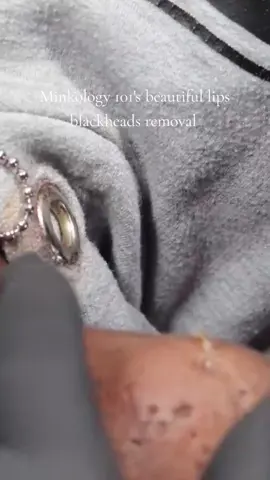 Minkology 101's beautiful lips blackheads removal #blackheads #pimple 