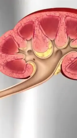O cálculo renal, também conhecido como pedra nos rins, é uma condição em que cristais formados a partir de substâncias presentes na urina, como cálcio, oxalato e ácido úrico, se acumulam nos rins ou nas vias urinárias. Esses cálculos variam em tamanho, podendo ser tão pequenos quanto grãos de areia ou tão grandes quanto uma bola de golfe. A formação de cálculos renais pode ser causada por vários fatores, incluindo desidratação, dieta rica em proteínas e sal, predisposição genética, infecções urinárias e certas condições médicas, como hiperparatireoidismo. Os sintomas mais comuns incluem dor intensa nas costas ou no abdômen (cólica renal), sangue na urina (hematúria), náuseas, vômitos, e necessidade frequente de urinar. A dor ocorre quando o cálculo se move pelos ureteres, causando bloqueio do fluxo urinário. O diagnóstico geralmente é feito por meio de exames de imagem, como ultrassom, tomografia computadorizada ou radiografias, e análise de urina para detectar a presença de cristais ou infecção. O tratamento depende do tamanho e localização do cálculo. Pequenos cálculos podem ser eliminados com aumento da ingestão de líquidos e analgésicos. Cálculos maiores podem necessitar de intervenções como litotripsia extracorpórea por ondas de choque (que quebra as pedras em pedaços menores), ureteroscopia, ou cirurgia para remoção. Prevenir a formação de novos cálculos envolve manter-se bem hidratado, ajustar a dieta para reduzir a ingestão de substâncias formadoras de cálculos (como sódio e oxalato), e, em alguns casos, tomar medicamentos prescritos para evitar a formação de pedras. #calculorenal #pedranosrins #pedrasnosrins #medical #anatomia #ar♿️ 