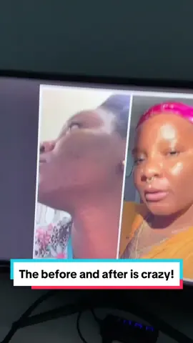 Hyperpigmentation is something alot of people struggle with!#hyperpigmentation #hyperpigmentationtreatment #hyperpigmentationtips 