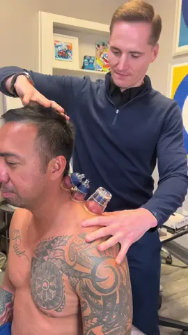 ⭕️Cupping Therapy⭕️  #foryou #fyp #drkyleross #sportstherapy #cuppingtherapy #chiropractor #chicago #satisfying  #asmr #oddlfysatisfying #hijama #china #japan #middleeast #dubai #chicago #trypophobia 