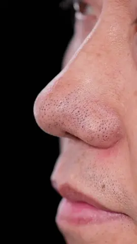 #coolwell #nosepatch #plantderived #nosestickers #nose #acne #skincare 