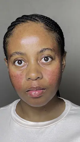 A boost in collagen helps fill in depressed scars making them appear smoother. I have atrophic scars, with the @BANISH Banisher i allow my skin to promote collagen production with less downtime.  Following the link in my bio use “SIMPHIWE” as the discount code to save.  #banishpartner #banish #banishacnescars #acnescars #acnetreatment #acnescartreatment 