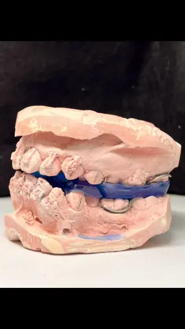 Twin Block modificado.        #twinblock #ortopedia #OFM #ortodoncia #tpd #tecnicodental #arttdental 