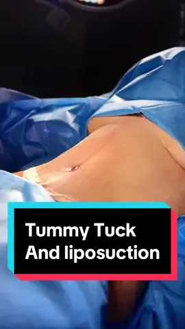 Tummy Tuck and High Definition Lipo 😍 @drradobocca Performed this incredible Tummy Tuck, along with Lipo, repairing her separated muscles, removing the loose skin and giving her a beautifully contoured body 🙌 This lady is beyond happy with her results, and we can’t wait to see her at her follow-ups! ✨ If you’d like to know more about a Tummy Tuck procedure - Comment ‘Tummy’ below 👇 #tummytuck #tummytuckuk #plasticsurgeon #plasticsurgery #plasticsurgerylondon #cosmeticsurgery #tummytuckresults #tummytuckjourney #bellavou