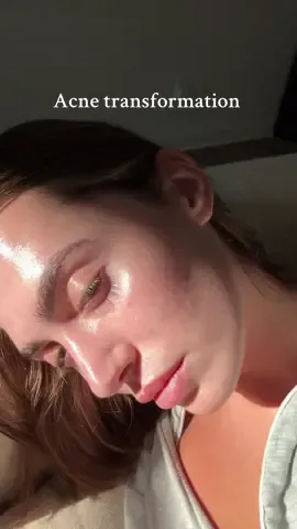 #acne 