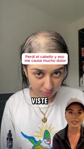 ¡Di adiós a la caída del cabello! El Aceite de Batana de Tgideas rejuvenece tu cuero cabelludo. #hairstyles#hairloss#hairtutorial#haircut#hair#tips#hairgrowth#batanaoil#healthyrecipes#alopecia#regrowhair#batanaoilbenefits