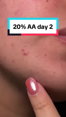 it is 2am so forgive the low volume but so far so good 😗 #acne #azelaicacid #postinflammatoryerythema 