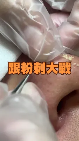 跟粉刺大戰幾回合？#粉刺 #有粉刺痘痘找艾姐 #全省都有姊妹店 #專業諮詢 #男女保養 #與粉刺分手  #療癒 