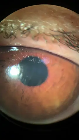 Hablamos sobre un caso avanzado de enfermedad ocular por diabetes. Enfatizamos la importancia de controlar los niveles de glucosa y cuidar la salud de los ojos. - Para más información no dudes en contactarme 📲+52 81 1073 2023 CédulaProfesional: 8965041 Especialidad: 11983652 Publicidad Cofepris: 2319012002A00220 #enfermedadesvisuales #vision #visionnublada #catarata #desprendimientoderetina #edemamacular #edemamaculardiabético #oftalmologo #retinopatiadiabetica #retina #glaucoma #diabetes  