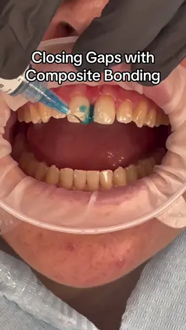Ever wondered how we can use composite bonding to close gaps in your smile? 🤔🎨 Your non-invasive solution to a new smile in a few hours - no needles, no drilling and no pain ✨ #compositebonding #compositeveneers  #smiletransformation #diastema #fyp