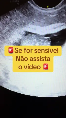 ⚕️O aborto no início da gestação é um tema que exige sensibilidade e conhecimento médico.  ⚕️O ultrassom, ferramenta essencial na avaliação gestacional, pode detectar a presença e o desenvolvimento do embrião nas primeiras semanas. Esse exame é crucial para determinar a viabilidade da gravidez e orientar as decisões médicas e legais.  ⚕️Em contextos onde o aborto é considerado, o ultrassom auxilia na identificação do tempo gestacional e no acompanhamento das condições de saúde da mulher, garantindo um cuidado médico seguro e informado.  #Ultrassom #SaúdeDaMulher #Medicina #CuidadosReprodutivos#aborto #ultrassomfortaleza #dralexalexandre 
