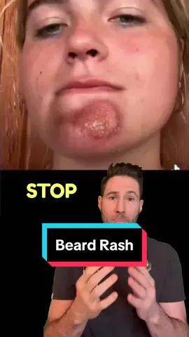 Impetigo is a highly contagious bacterial skin infection, often caused by *Staphylococcus aureus* or *Streptococcus pyogenes*. When it occurs on the chin after kissing someone with impetigo, it's likely that the bacteria were transmitted through close contact. The infection typically presents as red sores that quickly burst, leaving behind a yellowish crust. Treatment usually involves topical or oral antibiotics to clear the infection and prevent its spread. #impetigo #makingout #cellulitis #rash #doctor #skininfection #dermatology