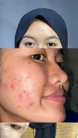 #tiaciptasuci #reviewtiaciptasuci #diresetscarlett #aquaresetbarrier #gelmoisturizer #acnepeace @Scarlett Whitening Official 