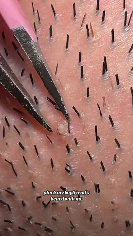 ingrown hairs & beard plucking  #beard #plucking #beardtok #hairpulling #satisfyingvideo #satisfying #trichotillomania #fypageシ #skinpicking #tweezing #fypage #asmrvideo #ingrownhair #pimple #pimplepopping 