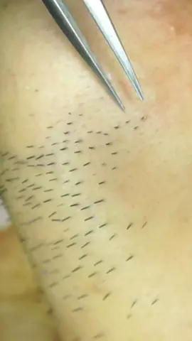 hair removal #pimple #blackheads #hairremoval 