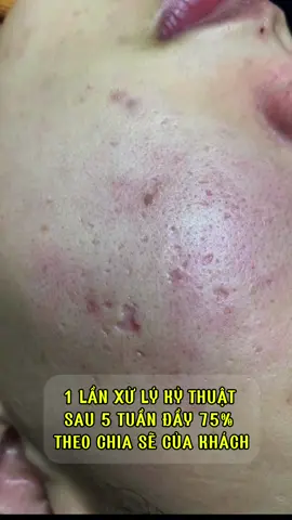 Sẹo rỗ sau 1 lần xử lý kỷ thuật, thấy em mừng mình cũng vui lay #chamsocdamun #dieutriseoro #daotaonghe #seoro #xuhuong #seo_rỗ_thuydau_tainan_loi_lom