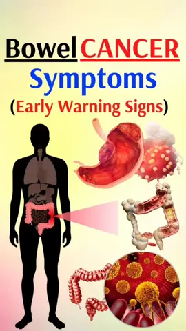 Bowel Cancer Symptoms (Early Warning Signs). #Bowel #BoweCancer #colon #coloncancer  #BowelHabits #stomach #digestion #diarrhea #constipation #Abdominal  #Discomfort #waste #Fatigue #Weakness #anemia #breath #WeightLoss #diet #Losingweight #exercise #fullness #bowelmovement #Bloating #health #healthy #usa #losangeles #chicago #sanfransisco #newyork #newyorkcity #illinois #alaska #lasvegas #california 