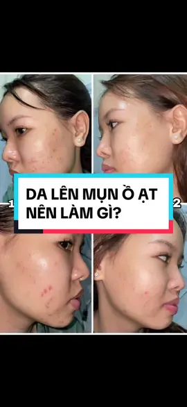 Da tự dưng lên mụn ồ ạt thì mấy bà thường làm gì? Tui chia sẻ bí quyết của tui nha #beautytips #damun #dahonhopthiendau #damunnenlamgi #trantapxinh 