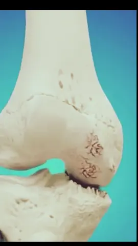 A infiltração com ácido hialurônico no joelho é um tratamento utilizado para aliviar a dor e melhorar a mobilidade em pessoas com artrose (osteoartrite) do joelho. A artrose é uma condição degenerativa que afeta as articulações, levando ao desgaste da cartilagem, inflamação e dor. Como Funciona: O ácido hialurônico é uma substância naturalmente presente no líquido sinovial das articulações, que atua como um lubrificante e amortecedor para reduzir o atrito entre os ossos. Na artrose, a quantidade e a qualidade do ácido hialurônico no joelho diminuem, contribuindo para a rigidez e dor. A infiltração consiste na injeção de ácido hialurônico diretamente na articulação do joelho, com o objetivo de: - Lubrificar a articulação: Melhorando a movimentação e reduzindo o atrito entre os ossos. - Amortecer os impactos: Atuando como um 