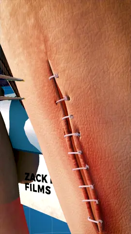 How Stitches Are Removed 🤔