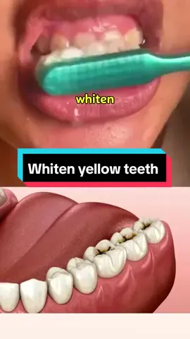 Natural Recipe : Whiten your yellow teeth and remove tartar in just two minutes. Transform your smile instantly with this easy recipe and make your teeth shine bright like pearls. #Recipe #remedy #yellowteeth #teethcare #teeth #teethwhitening #teethwhiteninghack #whiteningteeth #naturalremedy #naturalremedies 