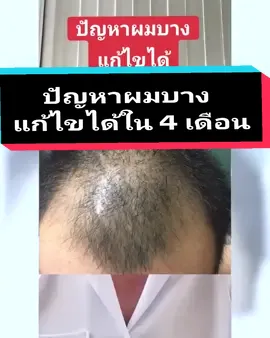 ปัญหาผมร่วงผมบางแก้ไขได้ด้วย havilah #ผมร่วง #ลดผมร่วง #แชมพูลดผมร่วง #ฮาวิล่าห์  #havilah 