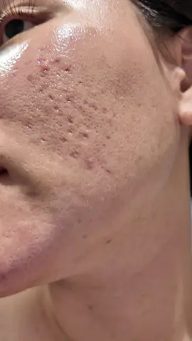 Hành trình điều trị sẹo rỗ của tuiii đã có kết quả 😘😘#seoro #dieutrimun #viral #jyp 