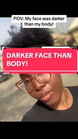 SKIN PROGRESS! #skinjorney #chocolateandcaramel #fyp