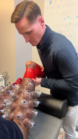 ⭕️Cupping Therapy⭕️  #foryou #fyp #drkyleross #sportstherapy #cuppingtherapy #chiropractor #chicago #satisfying  #asmr #oddlfysatisfying #hijama #china #japan #middleeast #dubai #chicago #trypophobia 