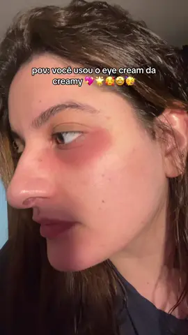 e ainda teve que ir pro estágio desse jeito 🤪 com o olho inchado, com mais linhas e queimada 🤩 me explica isso @Creamy Skincare #tiktokbeleza #skincare #BeautyTok #skintok #fyp #fypage 