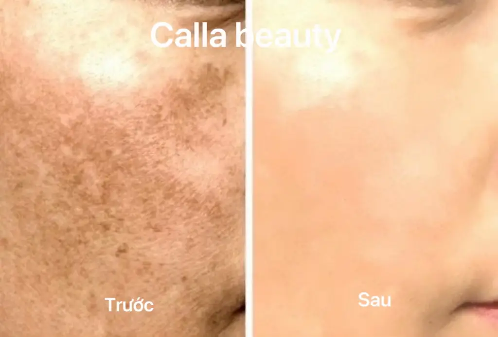 Da khách trước và sau 1 liệu trình t.r.i nám  #skincare #skincareroutine #điềutridakhoahoc #nám_tàn_nhang#trending#BeautyTok#trịnamtannhang 