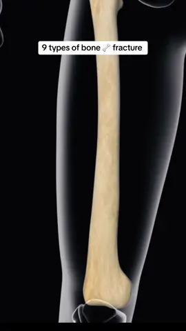 9 Different types of bone fractures 🧑‍⚕️#surgicalskills #bone #fracture #foryou  @Surgical skills 