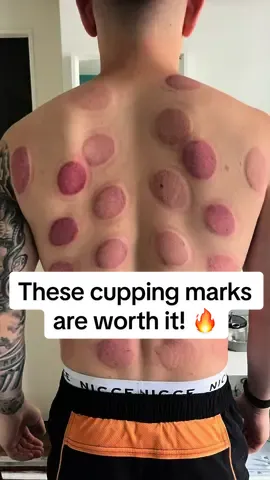 A full cupping session for this clinet. Who wants this ? #reliefgysportsmassage #cupping #drycupping #cuppingtherapy #cuppingasmr #asmr #asmrsounds #viral #fyp #explore 