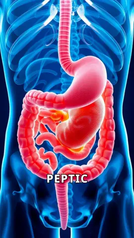 Understanding Peptic Ulcers: Causes, Symptoms, and Treatment. Don't ignore stomach pain—learn how to protect your digestive health! 🩺 #HealthTips #PepticUlcer 