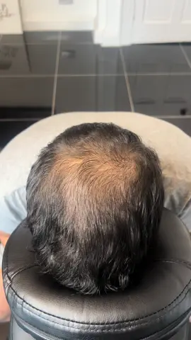 Crown Recovery 👑  Don’t let your crown get you down 👇🏼👇🏼 Phone | Message | WhatsApp | Visit 📞  07306 251 111 📍  14 Union St, Greenock, PA16 8JJ #scalpmicropigmentation #smp #hairlosssolution #hairline #crown #alopecia #alopeciascotland #glasgow #Scotland #ayrshire #greenock #inverclyde #smpscotland