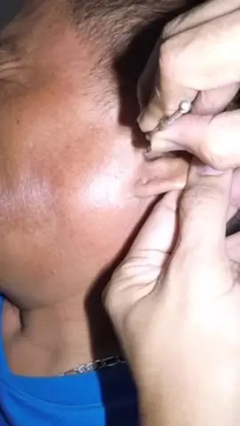 This one is Hard & Huge #earwaxspecialist #earwaxremoval #earcleaning 
